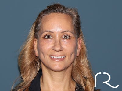 Fractional CO2 Laser Resurfacing Before & After Gallery - Patient 250242 - Image 2