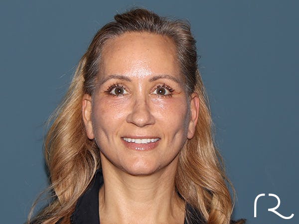 Fractional CO2 Laser Resurfacing Before & After Gallery - Patient 250242 - Image 2