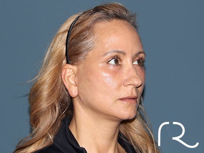Fractional CO2 Laser Resurfacing Before & After Gallery - Patient 250242 - Image 4
