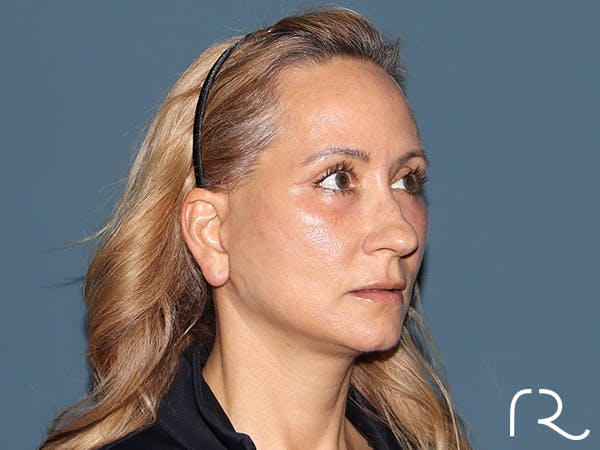 Fractional CO2 Laser Resurfacing Before & After Gallery - Patient 250242 - Image 4