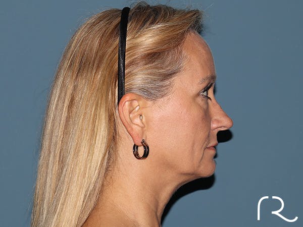 Fractional CO2 Laser Resurfacing Before & After Gallery - Patient 250242 - Image 5