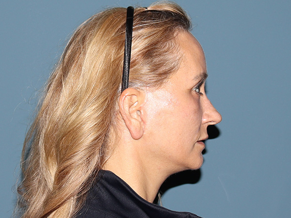 Fractional CO2 Laser Resurfacing Before & After Gallery - Patient 250242 - Image 6