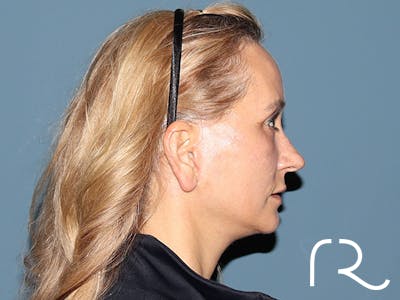 Fractional CO2 Laser Resurfacing Before & After Gallery - Patient 250242 - Image 6