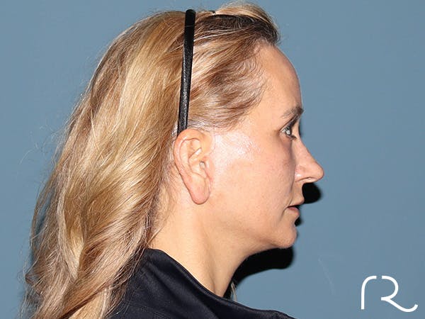 Fractional CO2 Laser Resurfacing Before & After Gallery - Patient 250242 - Image 6