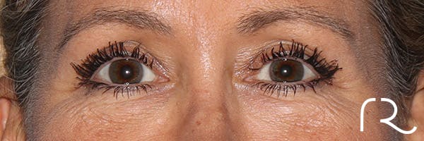 Eyelid Surgery Before & After Gallery - Patient 321018 - Image 1