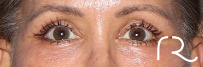 Eyelid Surgery Before & After Gallery - Patient 321018 - Image 2