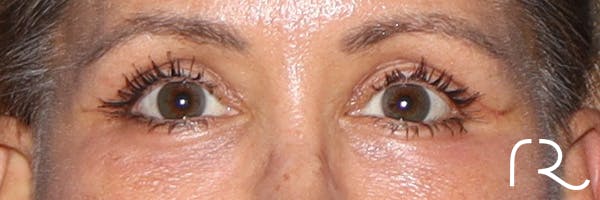 Eyelid Surgery Before & After Gallery - Patient 321018 - Image 2