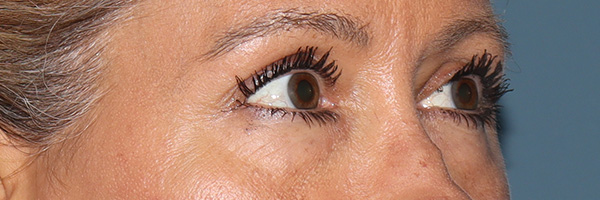 Eyelid Surgery Before & After Gallery - Patient 321018 - Image 3