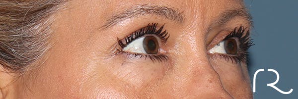 Eyelid Surgery Before & After Gallery - Patient 321018 - Image 3