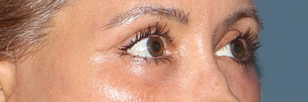 Eyelid Surgery Before & After Gallery - Patient 321018 - Image 4