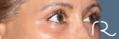 Eyelid Surgery Before & After Gallery - Patient 321018 - Image 4