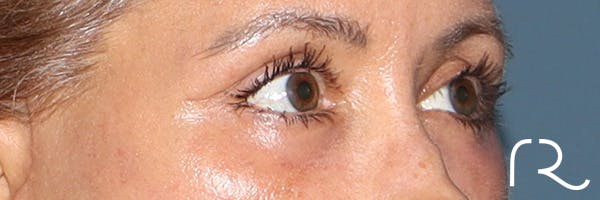 Eyelid Surgery Before & After Gallery - Patient 321018 - Image 4