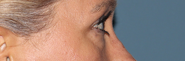 Eyelid Surgery Before & After Gallery - Patient 321018 - Image 5