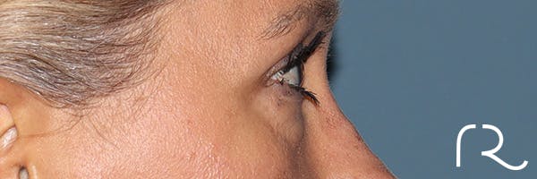 Eyelid Surgery Before & After Gallery - Patient 321018 - Image 5