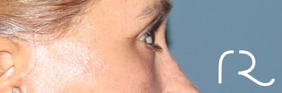 Eyelid Surgery Before & After Gallery - Patient 321018 - Image 6