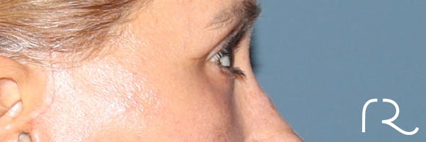 Eyelid Surgery Before & After Gallery - Patient 321018 - Image 6