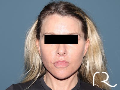 Facelift Before & After Gallery - Patient 117666 - Image 6