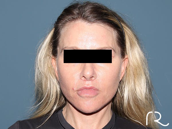 Facelift Before & After Gallery - Patient 117666 - Image 6