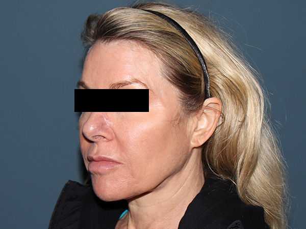 Neck Lift Before & After Gallery - Patient 398290 - Image 1