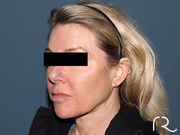 Facelift Before & After Gallery - Patient 117666 - Image 1