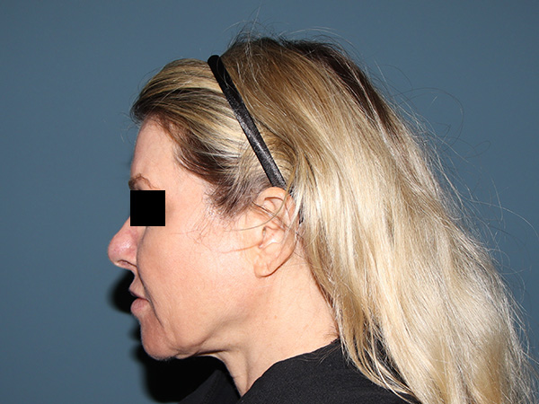Neck Lift Before & After Gallery - Patient 398290 - Image 3