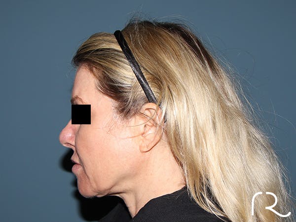 Facelift Before & After Gallery - Patient 117666 - Image 3