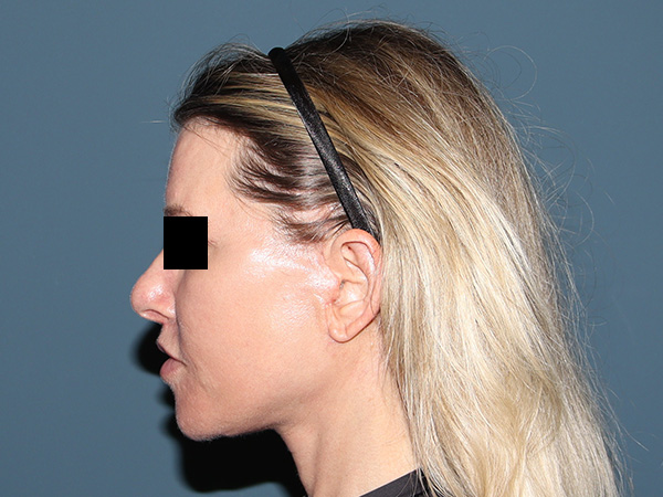 Neck Lift Before & After Gallery - Patient 398290 - Image 4