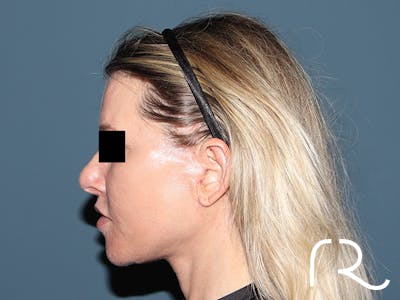 Facelift Before & After Gallery - Patient 117666 - Image 4