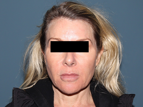 Fractional CO2 Laser Resurfacing Before & After Gallery - Patient 135460 - Image 1