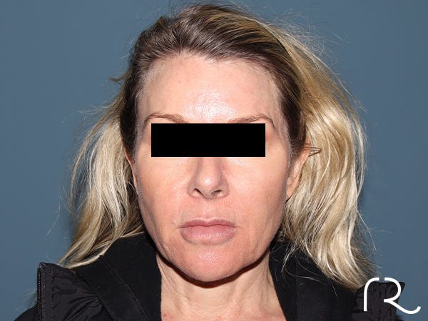 Facelift Before & After Gallery - Patient 117666 - Image 5