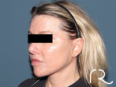 Facelift Before & After Gallery - Patient 117666 - Image 2