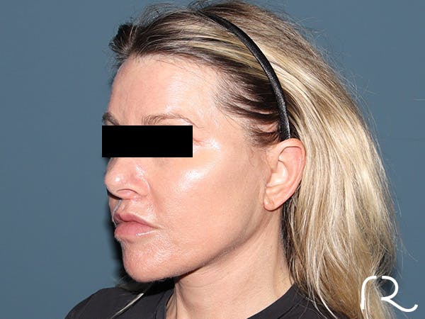Facelift Before & After Gallery - Patient 117666 - Image 2