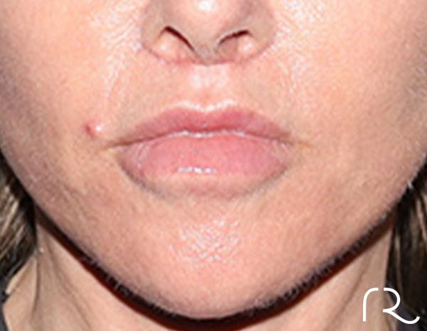 Lip Lift Before & After Gallery - Patient 257366 - Image 2