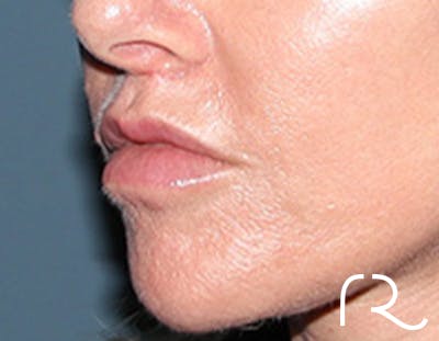 Lip Lift Before & After Gallery - Patient 257366 - Image 4
