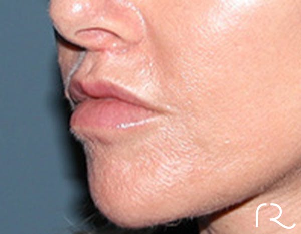 Lip Lift Before & After Gallery - Patient 257366 - Image 4