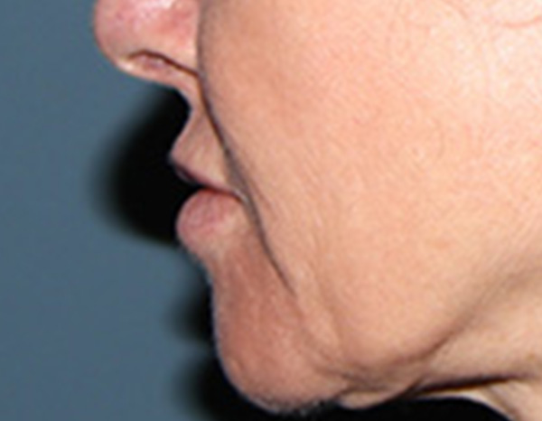 Lip Lift Before & After Gallery - Patient 257366 - Image 5