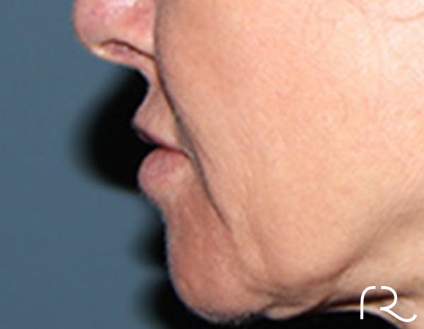Lip Lift Before & After Gallery - Patient 257366 - Image 5