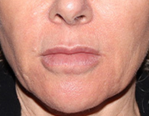 Lip Lift Before & After Gallery - Patient 257366 - Image 1