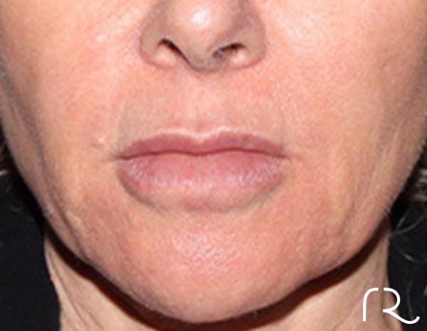 Lip Lift Before & After Gallery - Patient 257366 - Image 1