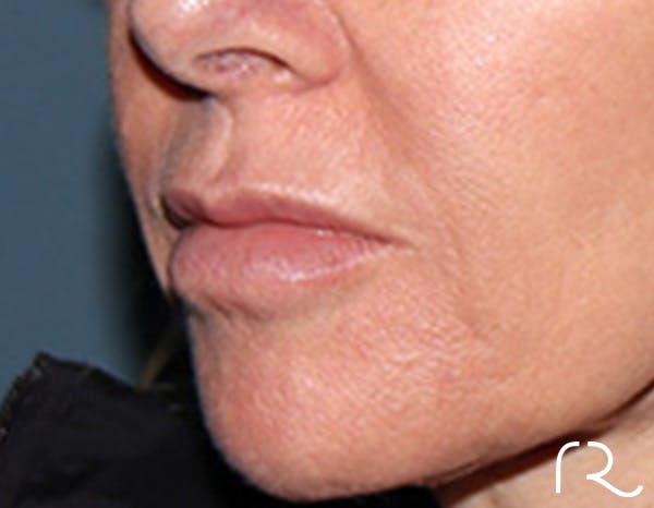 Lip Lift Before & After Gallery - Patient 257366 - Image 3