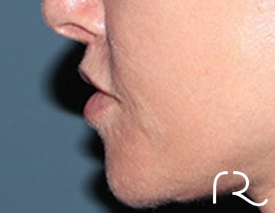 Lip Lift Before & After Gallery - Patient 257366 - Image 6