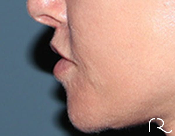 Lip Lift Before & After Gallery - Patient 257366 - Image 6