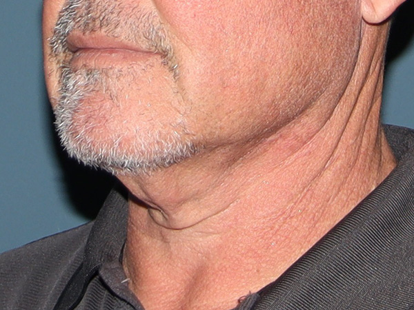 Neck Lift Before & After Gallery - Patient 199074 - Image 1