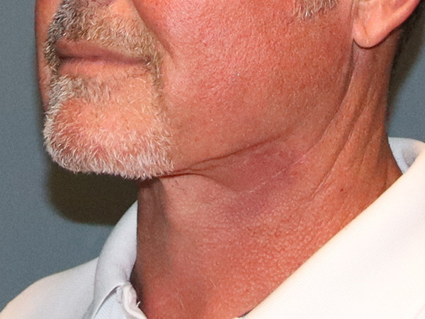 Neck Lift Before & After Gallery - Patient 199074 - Image 2