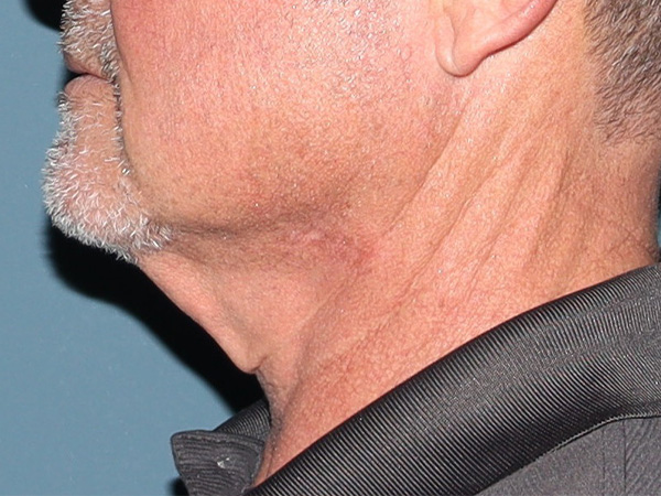 Neck Lift Before & After Gallery - Patient 199074 - Image 3