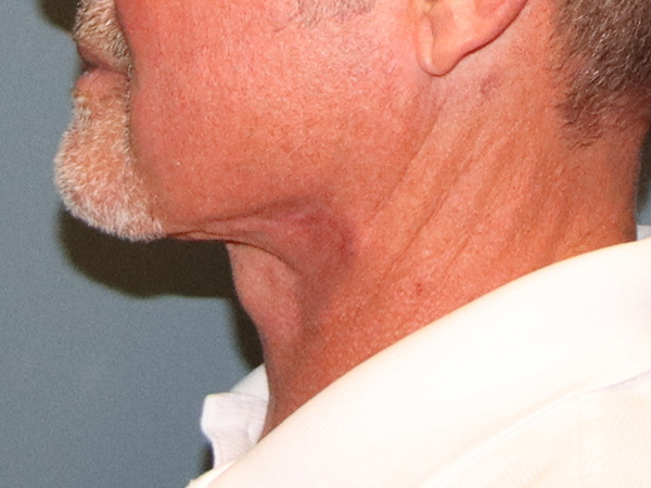 Neck Lift Before & After Gallery - Patient 199074 - Image 4