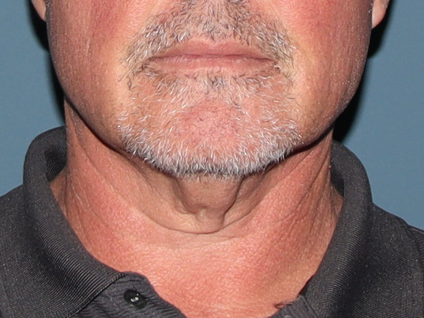 Neck Lift Before & After Gallery - Patient 199074 - Image 5
