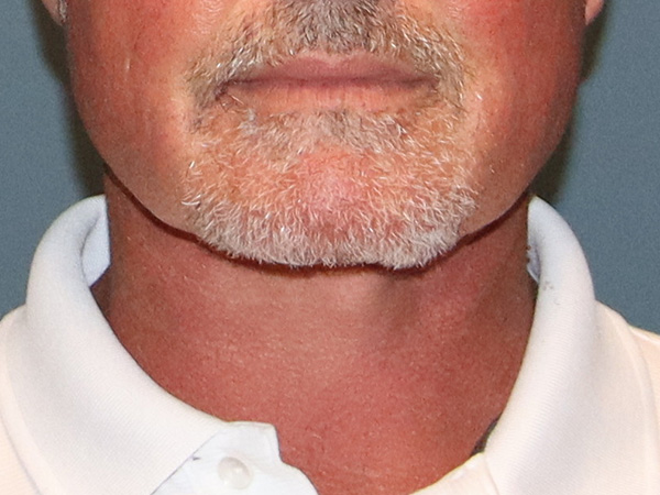 Neck Lift Before & After Gallery - Patient 199074 - Image 6