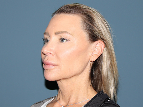 Neck Lift Before & After Gallery - Patient 415495 - Image 1