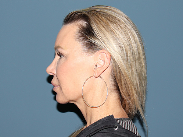 Brow Lift Before & After Gallery - Patient 304309 - Image 5